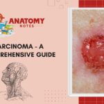 Carcinoma - A Comprehensive Guide