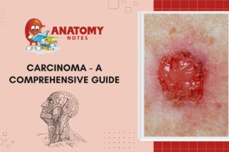 Carcinoma - A Comprehensive Guide