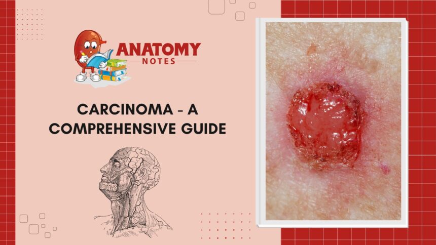 Carcinoma - A Comprehensive Guide